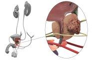 ЗППП как фактор риска раковых опухолей