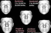 3D-изображения лица позволяют выявить редкие генетические заболевания