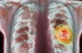 Анализ крови выявляет рак легких на ранних стадиях