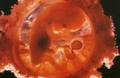 Британские врачи сделают аборт 11-летней румынке